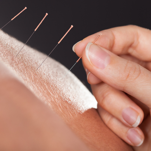 Voorbeeld van acupunctuur behandeling